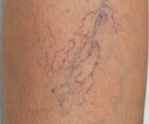 the extension of the varicose veins
