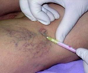 the prick-of-varicose veins