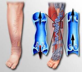 blood flow in leg with varicose veins