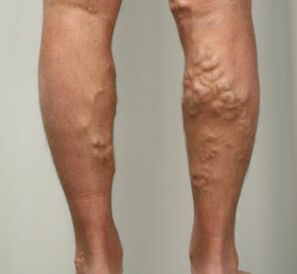 lymph nodes in the legs with varicose veins