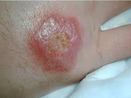ulcers in the skin,