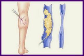 Sclerotherapy is a popular method of getting rid of varicose veins on the legs. 