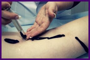 The procedure to treat varicose veins with leeches (hirudotherapy)