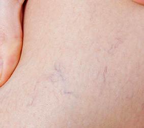 the stage of varicose veins