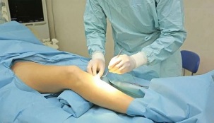 How is the operation for varicose veins performed