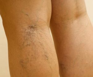the pain of varicose veins treatment