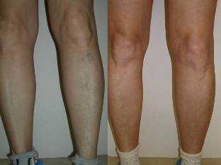the signs of varicose veins