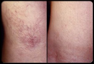 Before and after sclerotherapy. 