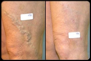 Before and after vein surgery. 