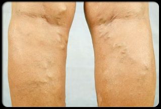 Varicose veins on the legs. 