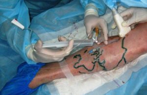 how to get rid of the operation of varicose veins