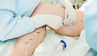 methods to treat varicose veins in the legs in women