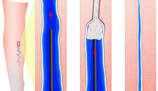 Introduction sclerosing sclerotherapy