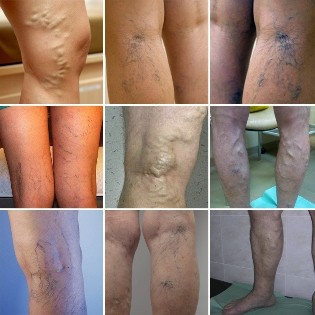 Photo varicose veins of the veins of the lower extremities